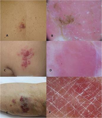 Frontiers | Primary Cutaneous B-Cell Lymphomas: An Update